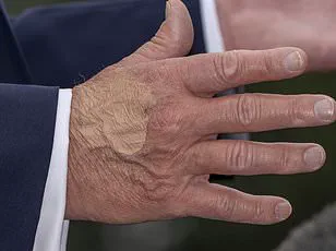 Trump Defies Medical Advice with High-Dose Aspirin Regimen, Experts Warn of Health Risks