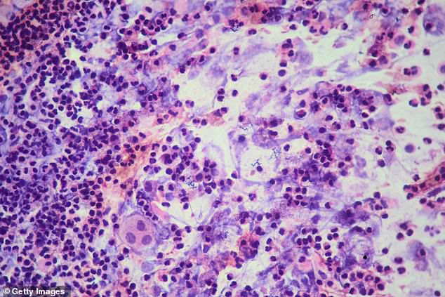 Behind Closed Doors: TB Outbreak at Prestigious School Raises Public Health Concerns and Expert Advisories