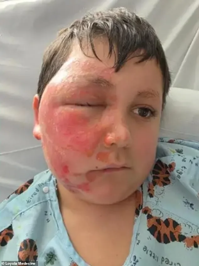 14-Year-Old Girl's Life-Threatening Burns After Social Media 'Fire-Breathing' Challenge Prompt Fire Marshal Warning