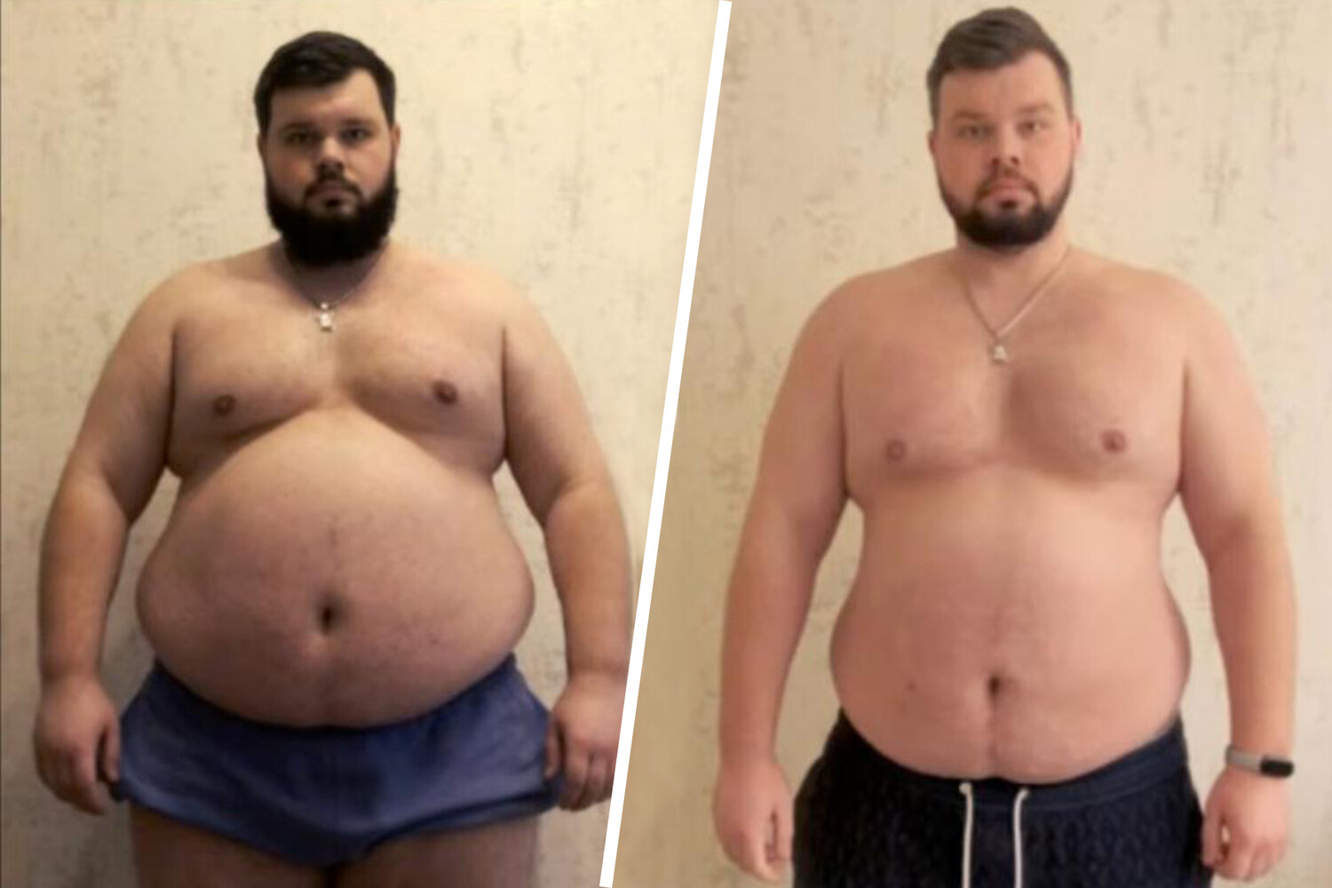 Forced Conscription of Obese Man with Chronic Illness Sparks Controversy in Ukraine