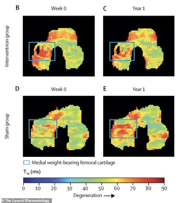 Stanford Study: Simple Foot Angle Shifts Could Ease Knee Osteoarthritis Pain