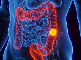 Study Links Birth Weight to Rising Bowel Cancer in Young Adults
