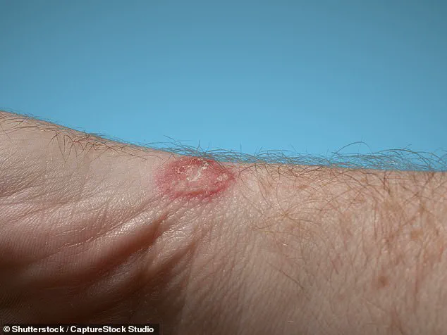 Retail Worker Warns Shoppers to Wash New Clothes After Contracting Ringworm