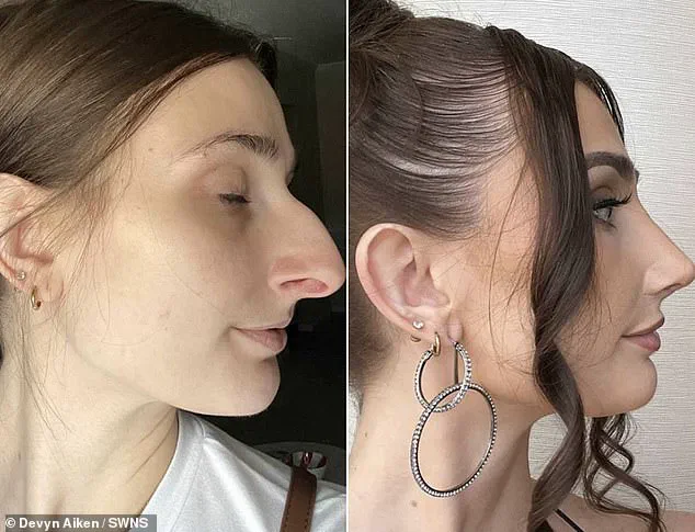 Transformation and Empowerment: Devyn Aiken's $11,000 Nose Job Journey